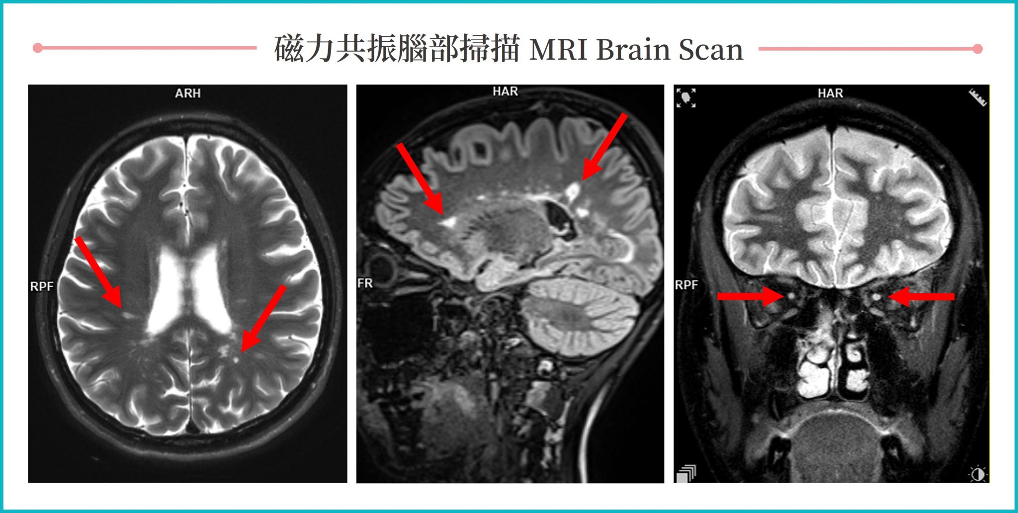 Are headaches and numbness in hands & feet the early signs of Multiple
