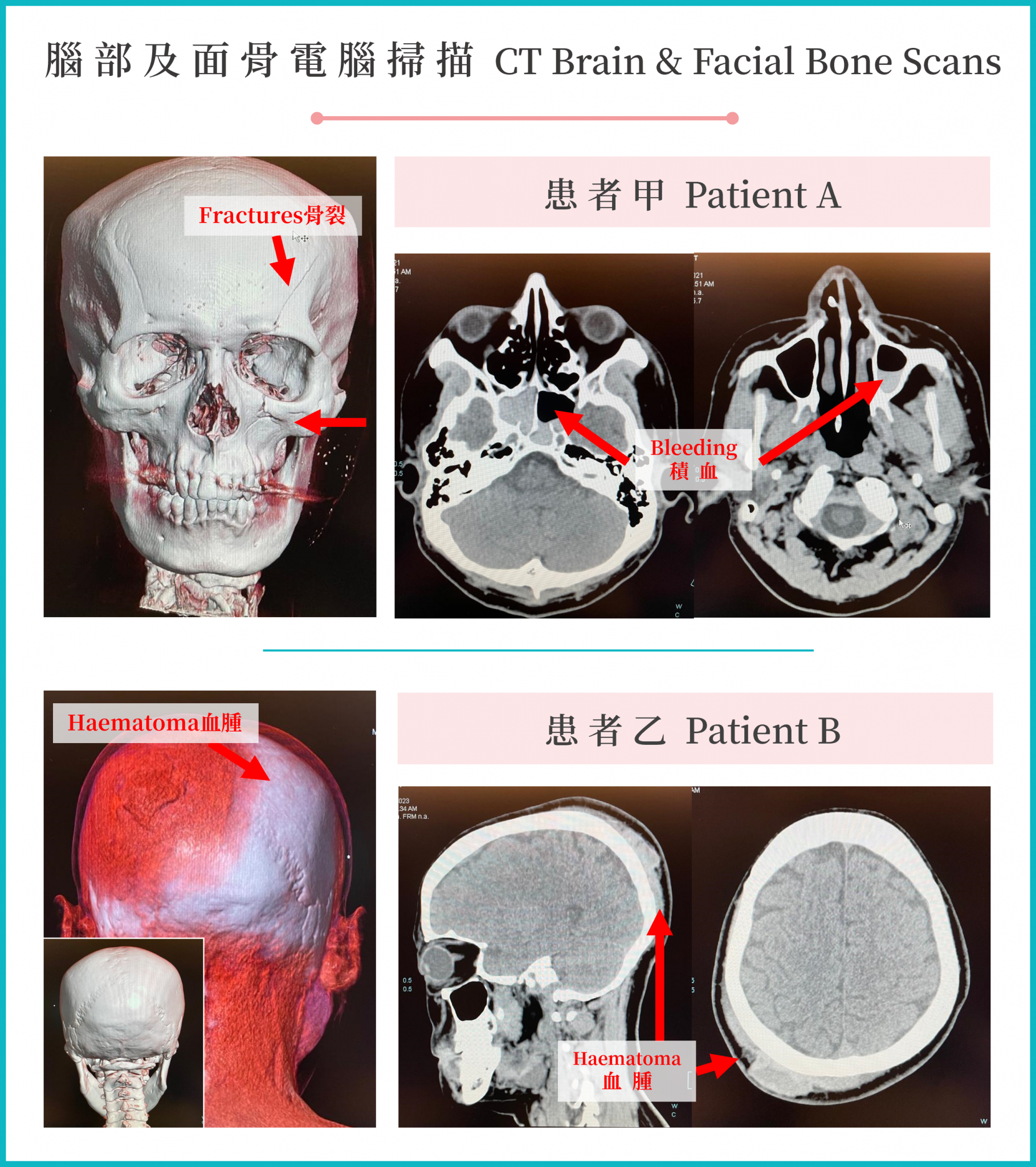 Computed Tomography (CT): Head Injury | 聖德肋撒醫院-掃描部 | St. Teresa’s ...