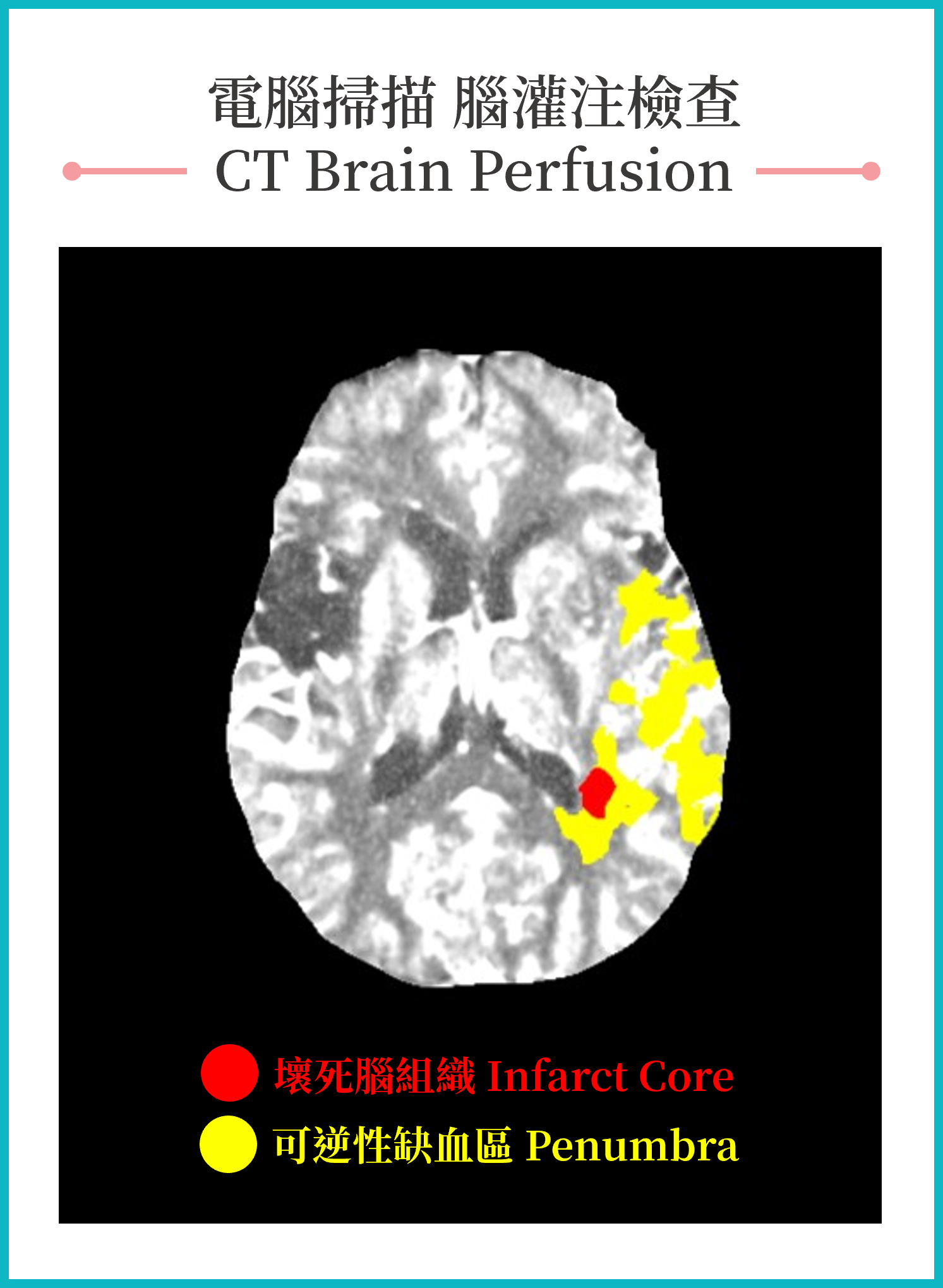 CT Brain Perfusion after Ischaemic Stroke | 聖德肋撒醫院-掃描部 | St. Teresa’s ...