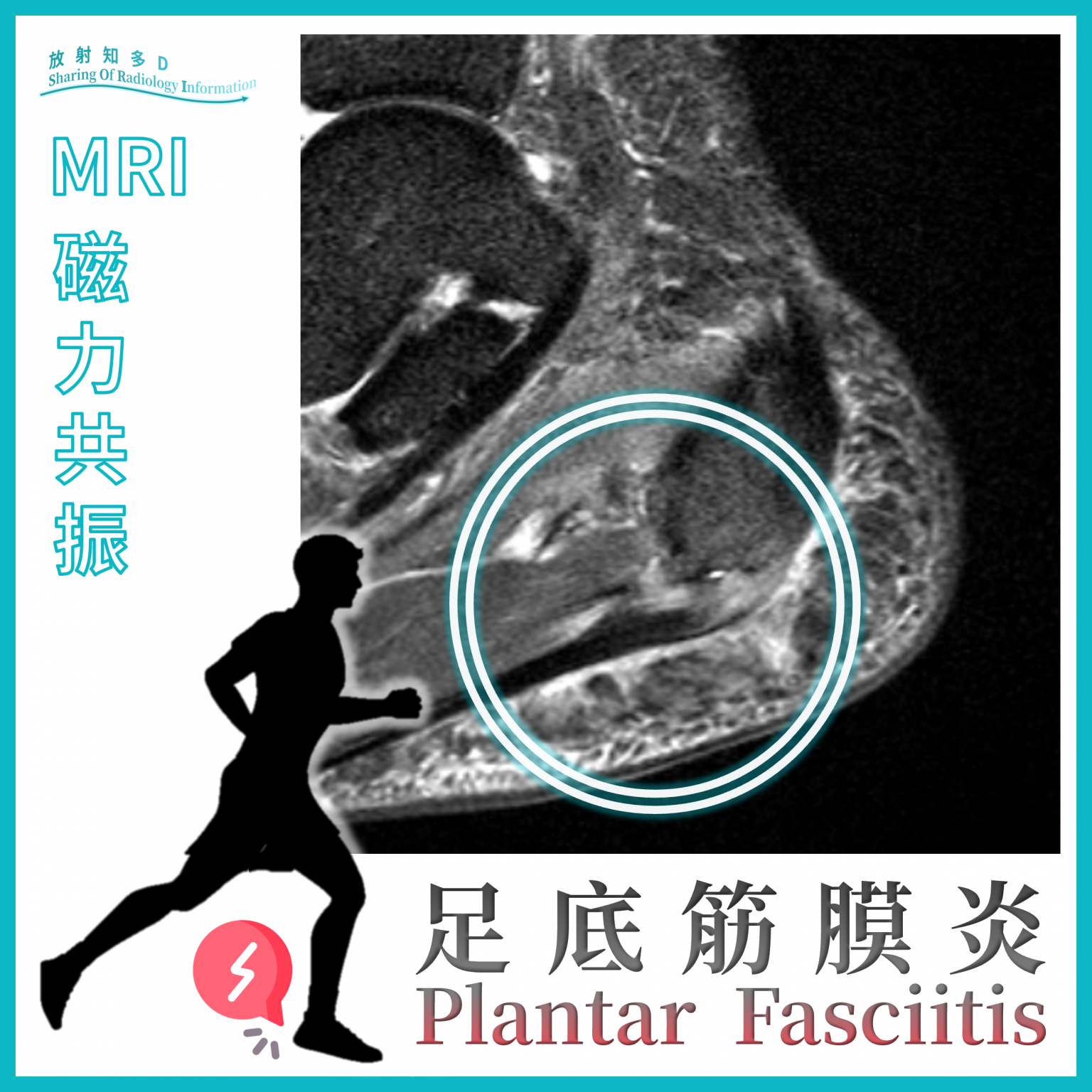Magnetic Resonance Imaging (MRI): Plantar Fasciitis | 聖德肋撒醫院-掃描部 | St ...