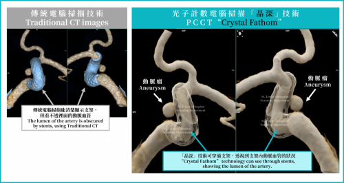 3. Stents