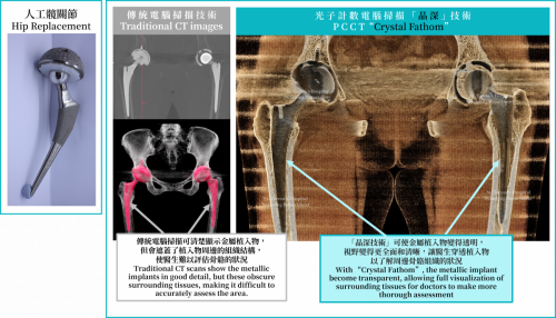 5. Hip replacement