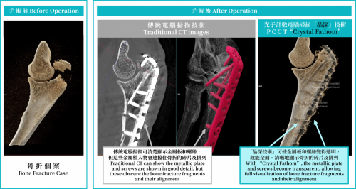 6. Bone Fracture