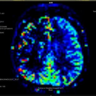 Arterial Spin Labelling
