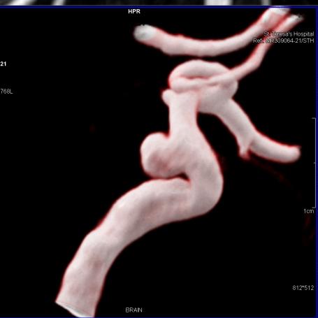 Brain MRA - Volume Rendering