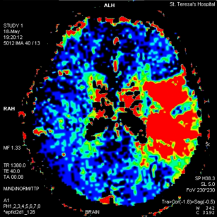 Brain Perfusion - Ischaemia Assessment