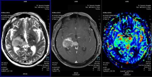 Brain Perfusion - Tumor Characterization