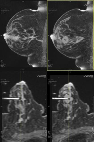 Breast - MRI Guided Biopsy