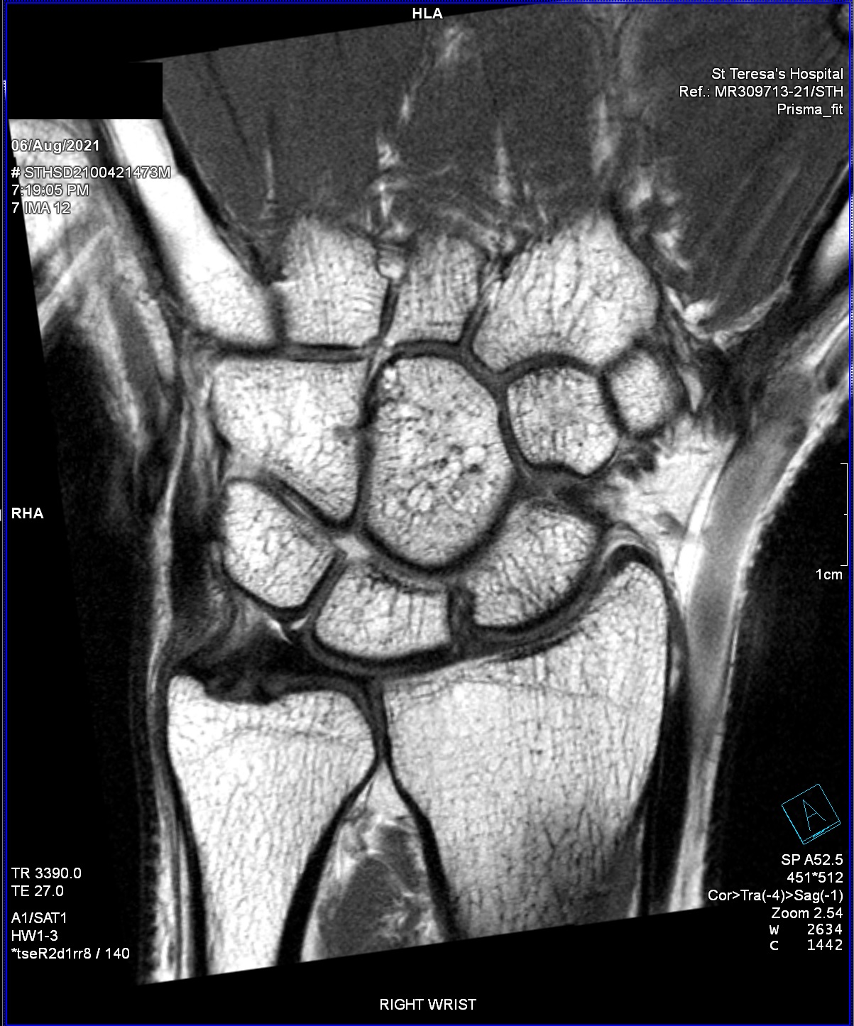 High Resolution Small Part (Wrist)