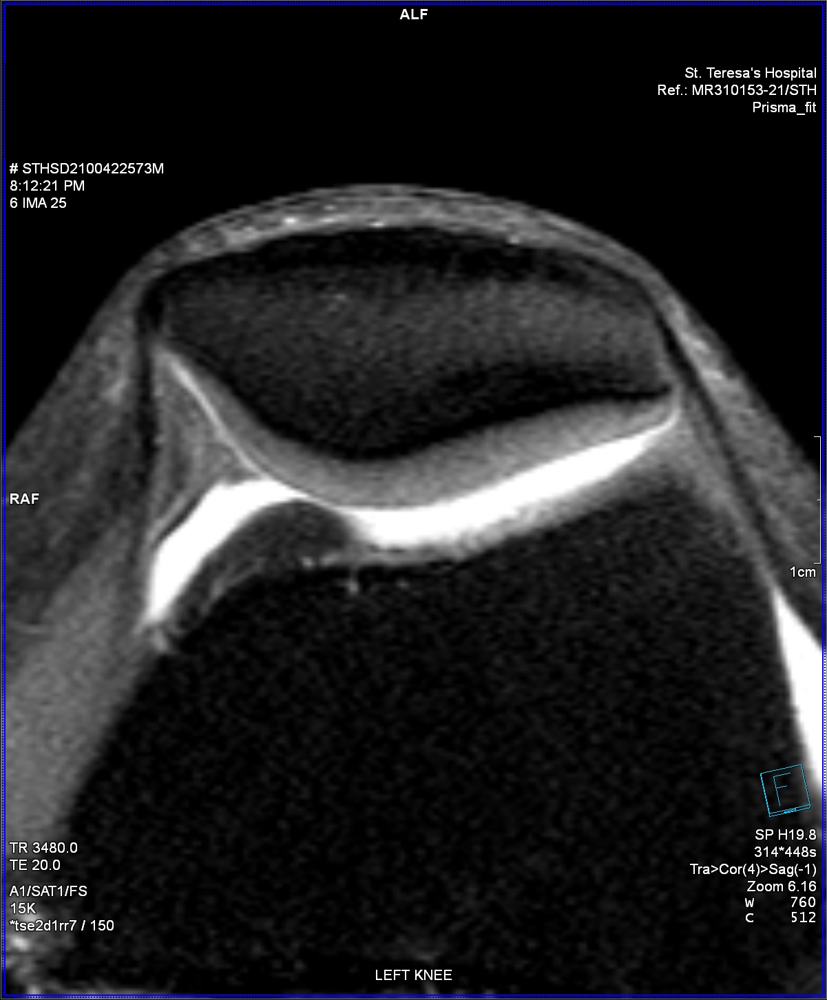 Knee - Cartilage