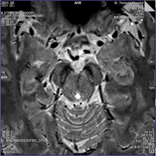 Movement Disorder Imaging - Nigrosome Imaging