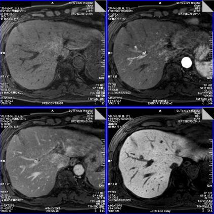Liver Specific - Contrast Agent