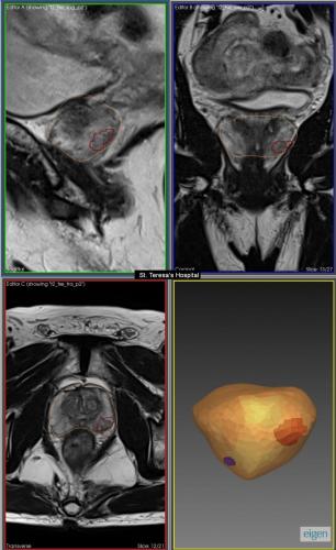 Prostate - MRI Guided Fusion Biopsy