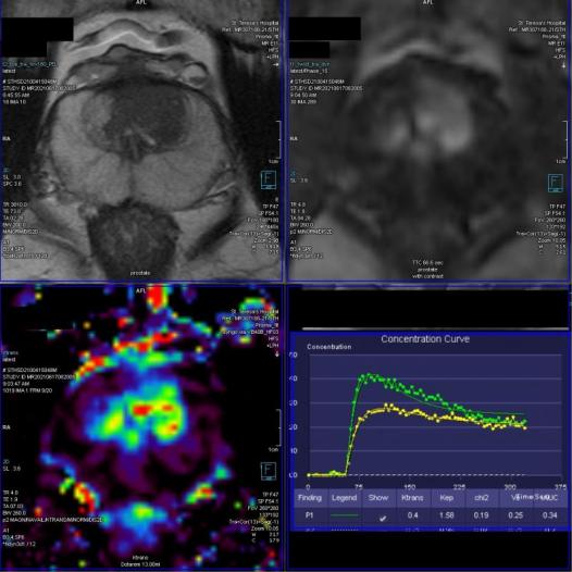 Prostate - Multiparametric Imaging
