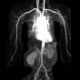 Whole Body MRA