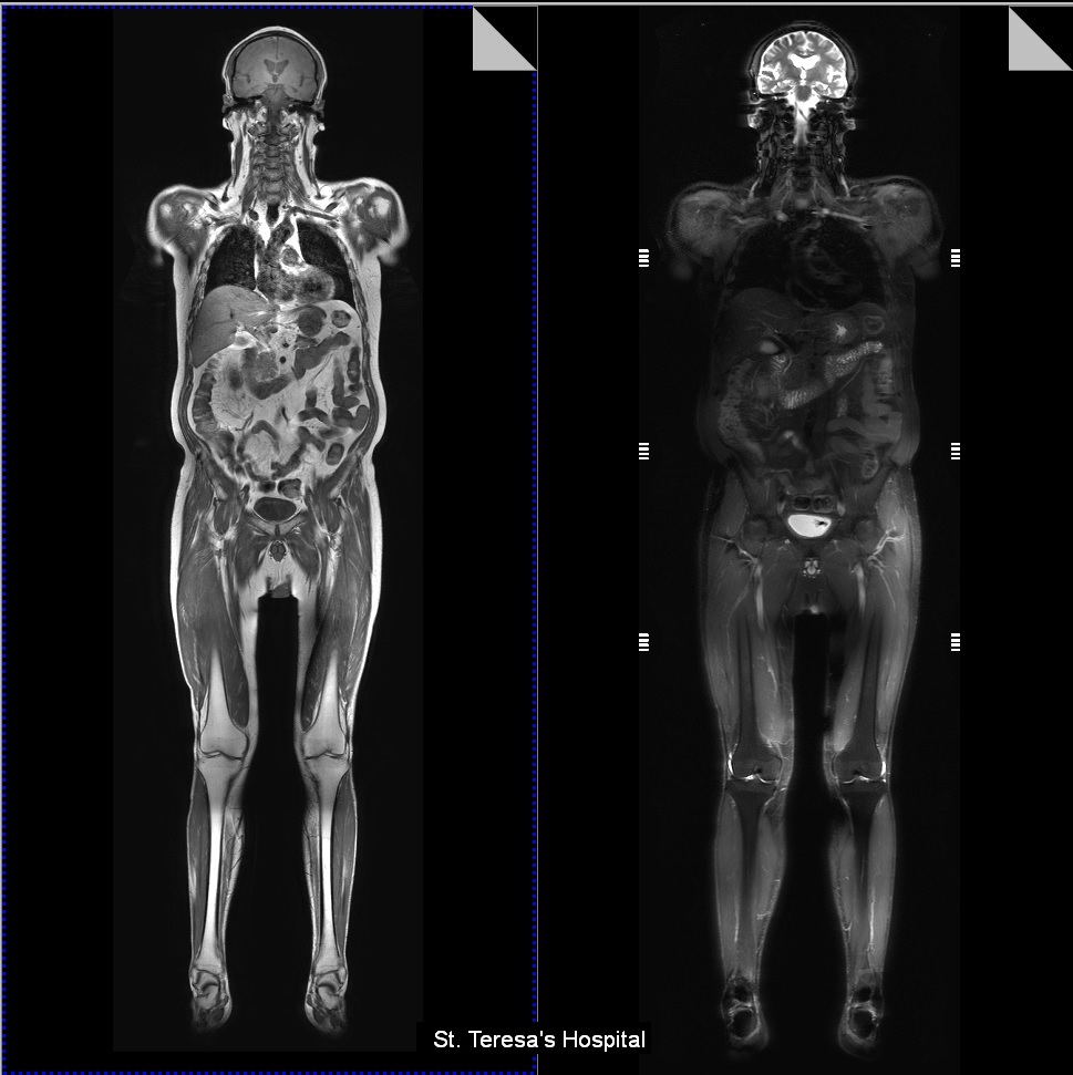Whole Body Screening